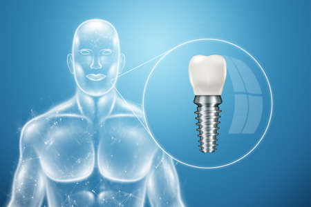 Dental implant, stainless steel post on cinemphon, medical information poster. Teeth replacement concept, dentures. 3D illustration, 3D graphicsの写真素材