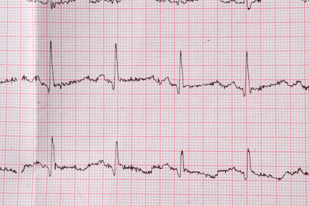 Heart electrocardiogram EKG chart on special paper. Concept for heart scan, health insurance,...