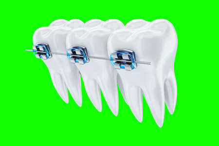 White teeth with metal braces on a blue background. Dental braces, orthodontic treatment, dentistry, teeth whitening, protection, oral care, hygiene, healthcare. 3D illustration, 3D renderingの写真素材