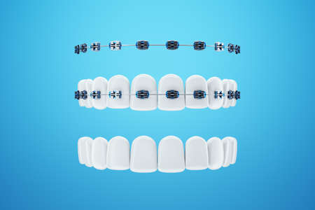 White teeth with metal braces on a blue background. Dental braces, orthodontic treatment, dentistry, teeth whitening, protection, oral care, hygiene, healthcare. 3D illustration, 3D renderingの写真素材