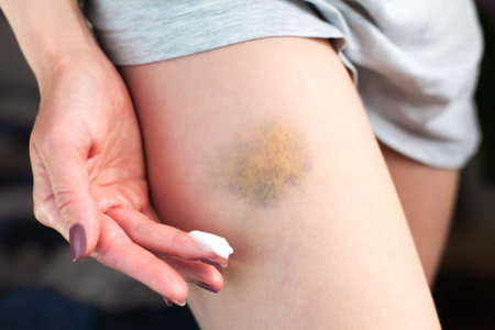 A young woman applies a healing cream to a bruise on the leg. Treating a bruise at home. Domestic violence. Close-up.の写真素材