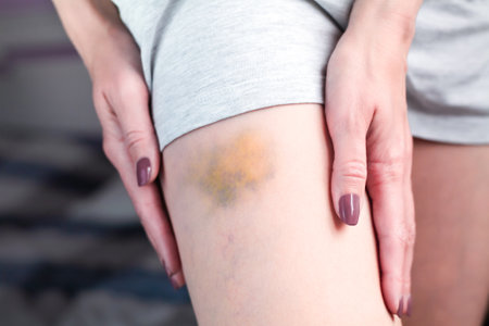 Bruise on the leg of a woman. A bruised leg. Close-up.の写真素材