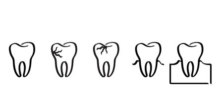 Cartoon healthy, tooth with gums, line pattern. Vector drawing silhouette icon. Damage teeth or tooth with caries. Cracked tooth, mouth and dental, damaged. Strang enamel, disease.のイラスト素材