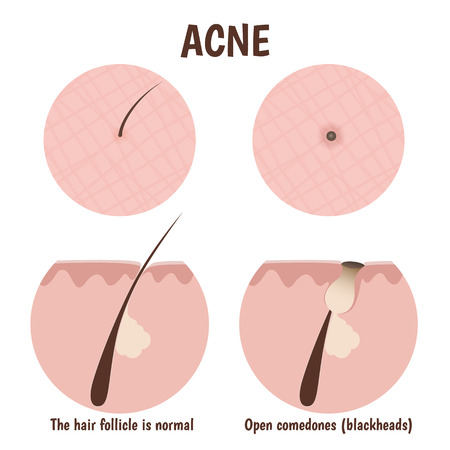 structure of the hair follicle, problematic skin with blackheadsのイラスト素材