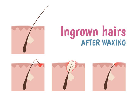 structure of the hair follicle, ingrown hairs when shaving and depilationのイラスト素材