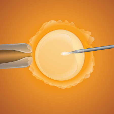 in vitro fertilization, the egg is the holding pipette and needle close up on a yellow backgroundのイラスト素材