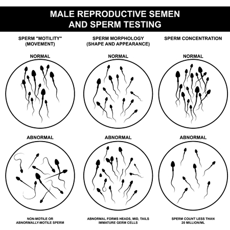 Spermogram and semen parameters, oligozoospermia, asthenozoospermia, teratozoospermia, normal and abnormal spermのイラスト素材