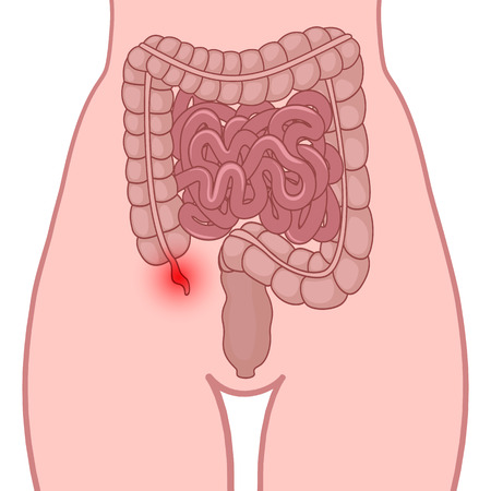 Appendicitis, an inflammation of the appendix, the location of the small and large intestine in the human bodyのイラスト素材
