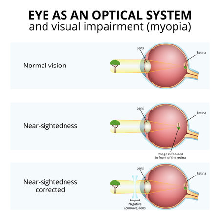 structure of the eyeball, visual impairment, near-sightednessのイラスト素材