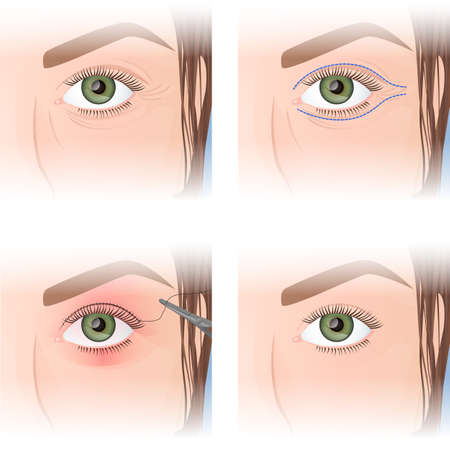 blepharoplasty, upper eyelid plastic, before and after imagesのイラスト素材