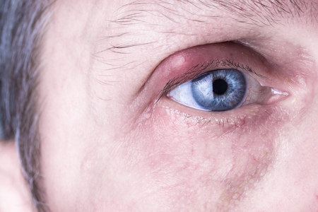Infected purulent eye. close up of the eyelid infection during eye examinationの写真素材