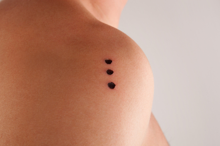 Handsome man with sapo burns - dots on shoulder isolated. Kambo, traditional amazon frog medicine.の写真素材