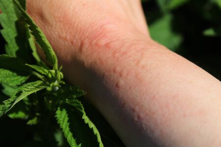 stinging nettles and an arm with nettle stingsの写真素材