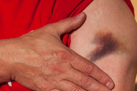 Big bruise on the male hands. Painful accident. Left arm injuredの写真素材