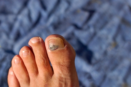 Fingernail with bruises. Injured thumb on leg.  Blood clot underneath the nailの写真素材