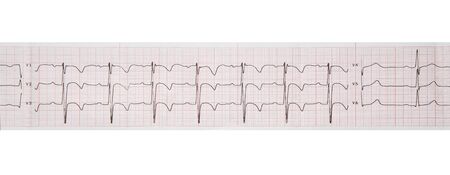 Medical research. Electrocardiogram. Isolated on white color.の写真素材