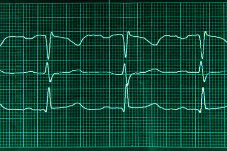 Medical research. Electrocardiography. Normal electrocardiogram with arrhythmia elements. The heartbeat lines on the monitor screen are green.の写真素材