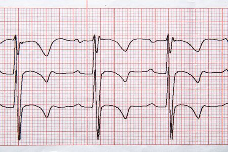Medical research. Fragment of a normal children's electrocardiogram with arrhythmia elements.の写真素材
