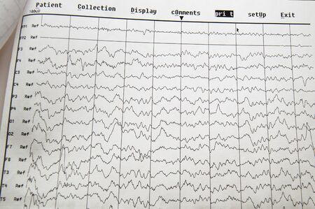 EG electro physiological monitoring method. EEG wave in human brain, EEG of the child, problems in the electrical activity of the brainの写真素材