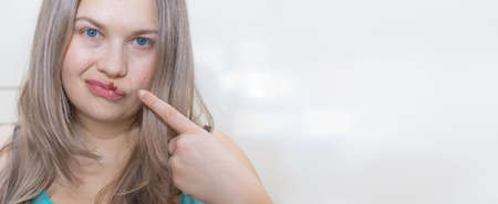 Herpes virus girl banner with place for text. Young woman with herpis virus on her lip, touching her lip with her finger. Beauty dermatology concept. Human papilloma virus, viral infectionの写真素材