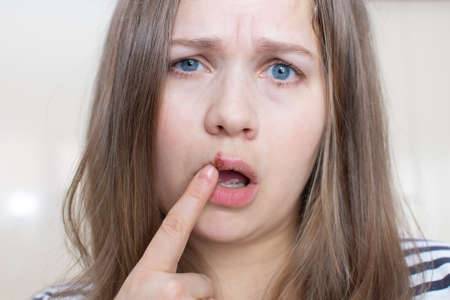 Virus herpes lips girl. Young woman with herpes on her lip, touching with her finger. Treatment of herpes infection and virus. Beauty dermatology concept. Human papillomavirus, viral infection.の写真素材