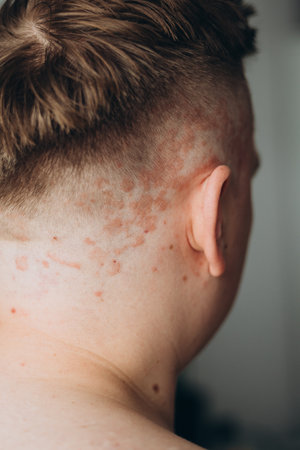 Psoriasis on the skin close-up, scalp, photos of dermatitis and eczema, skin problems concept, dermatology bannerの写真素材