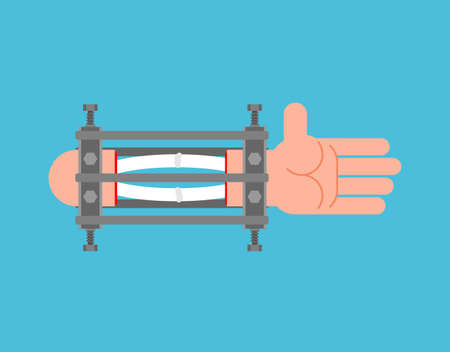 Ilizarov apparatus for arm. Compression-distraction apparatus. Bone splicing apparatusのイラスト素材