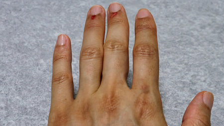 Hangnails