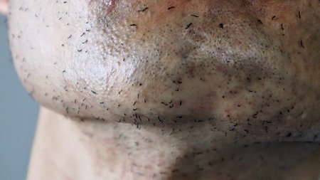 Japanese man's skin immediately after laser hair removal