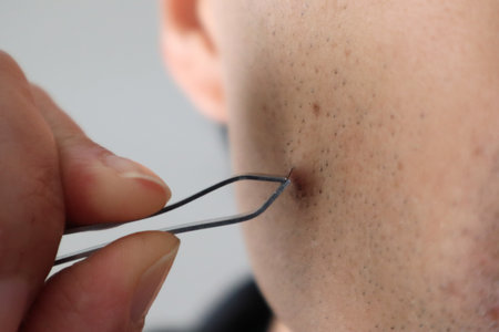 A person plucking ingrown hairs from his beardの写真素材