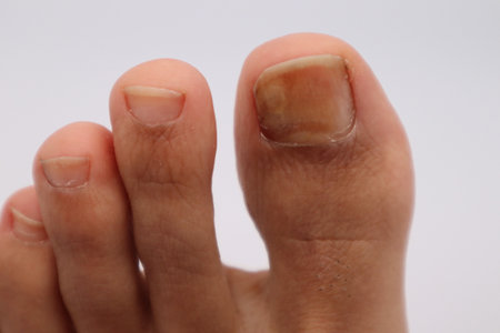 sore thumb nailの写真素材