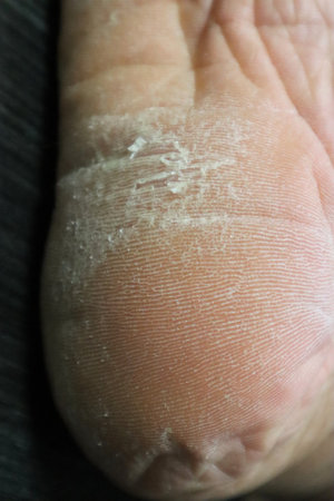 Close-up of dry heels
