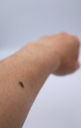 Large mole on arm