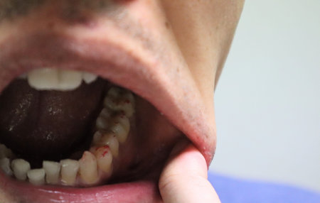 Teeth immediately after cavity treatment