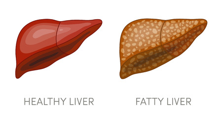fatty liver ロイヤリティフリー素材 高品質ストックフォトの
