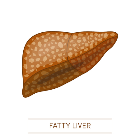 Fatty liver disease. Vector illustration of a fatty liver in cartoon styleのイラスト素材