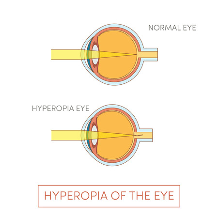 Hyperopia of the eye, vector illustrationのイラスト素材