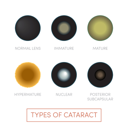 Types of cataract, vector. Human eye disorderのイラスト素材