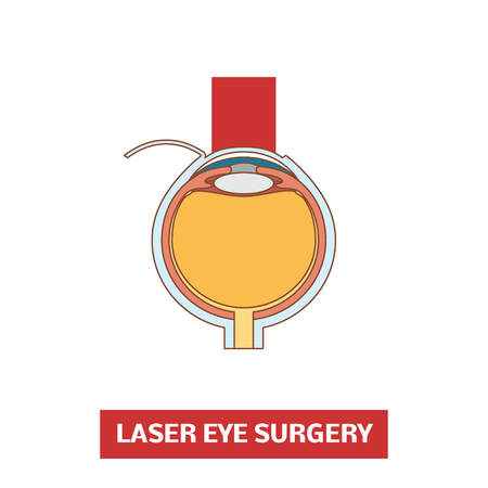 Laser eye surgery, vector illustrationのイラスト素材