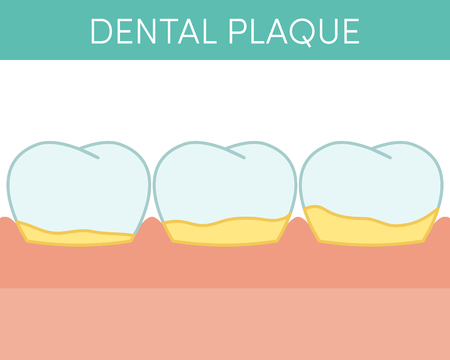 Dental plaque concept. Vector illustration of human molar teeth with oral biofilmのイラスト素材