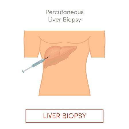 Percutaneous liver biopsy, simple vector illustrationのイラスト素材