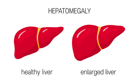 Hepatomegaly concept. Vector illustration of a healthy and an enlarged liver in cartoon styleのイラスト素材