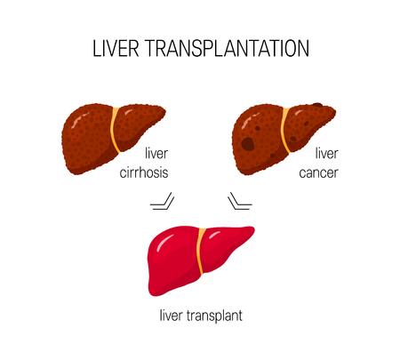 Liver transplantation concept in cartoon styleのイラスト素材