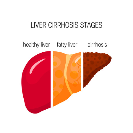 Liver cirrhosis concept. Vector illustration of healthy, fatty and cirrhosis liver in cartoon styleのイラスト素材