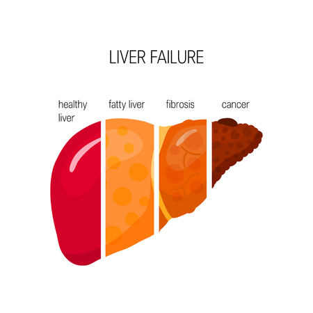 Liver failure concept. Vector illustration of healthy, fatty and fibrotic liver and HCC in flat styleのイラスト素材
