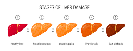 Stages of liver damage concept. Vector illustration of healthy liver, steatosis, NASH, fibrosis and cirrhosis in cartoon styleのイラスト素材