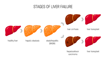 Stages of liver failure concept. Vector illustration of healthy liver, steatosis, NASH, cirrhosis and cancer in cartoon styleのイラスト素材