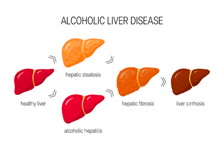Stages of alcoholic liver disease. Vector illustration of healthy liver, steatosis, hepatitis, fibrosis and cirrhosis in cartoon styleのイラスト素材