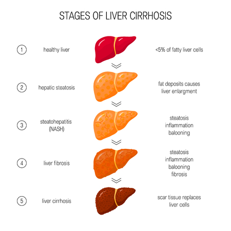 Stages of liver failure concept. Vector illustration of healthy, fatty, NASH, fibrotic and cirrhotic liver in flat styleのイラスト素材