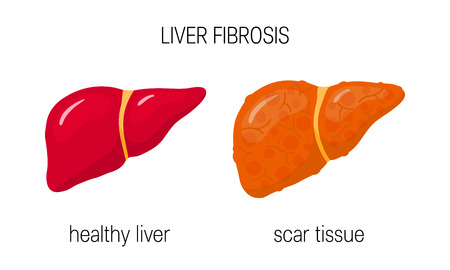 Liver fibrosis concept. Vector illustration of healthy and damaged liver in flat styleのイラスト素材
